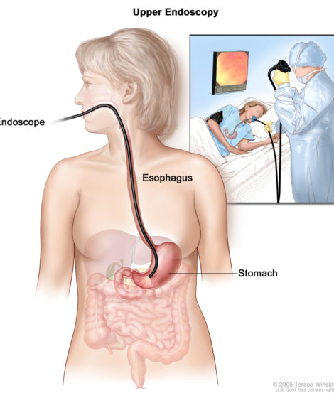 Upper Endoscopy