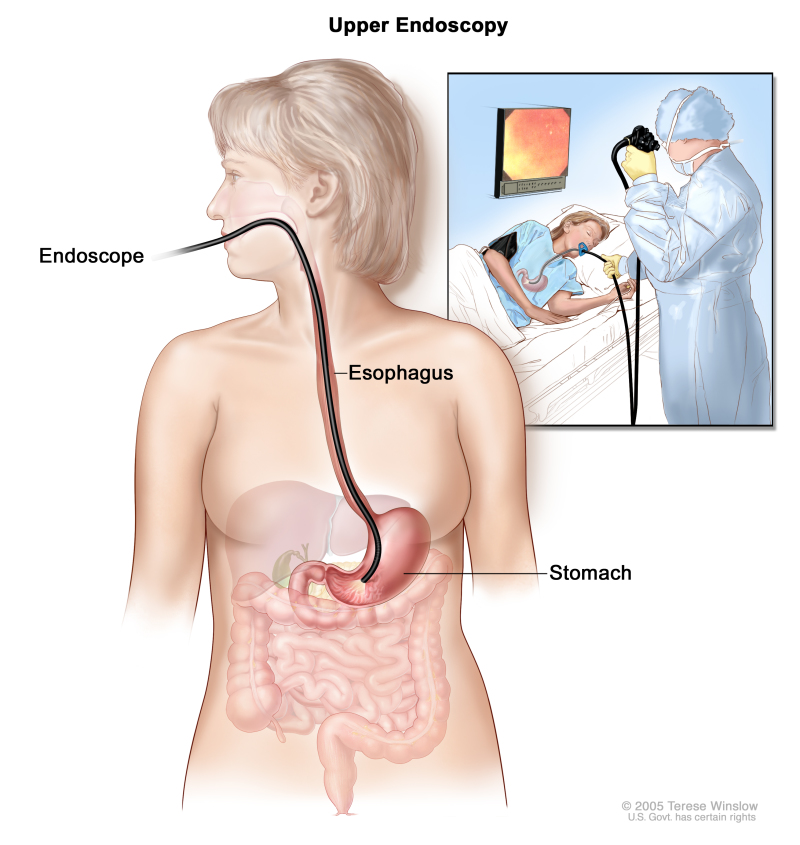 Upper Endoscopy