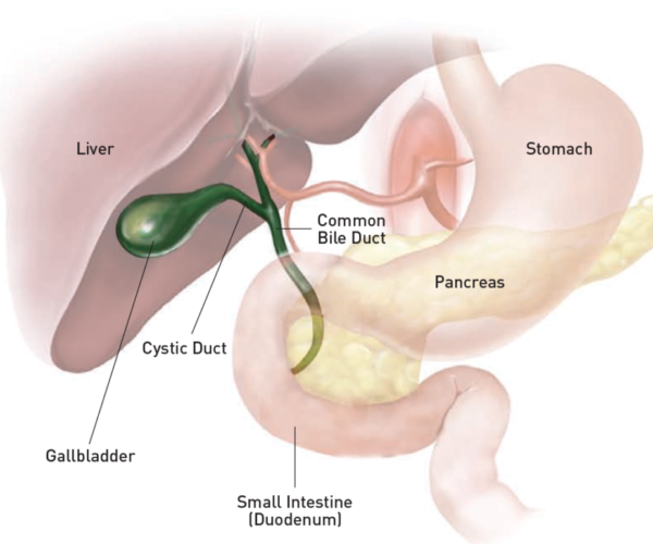 gallstones