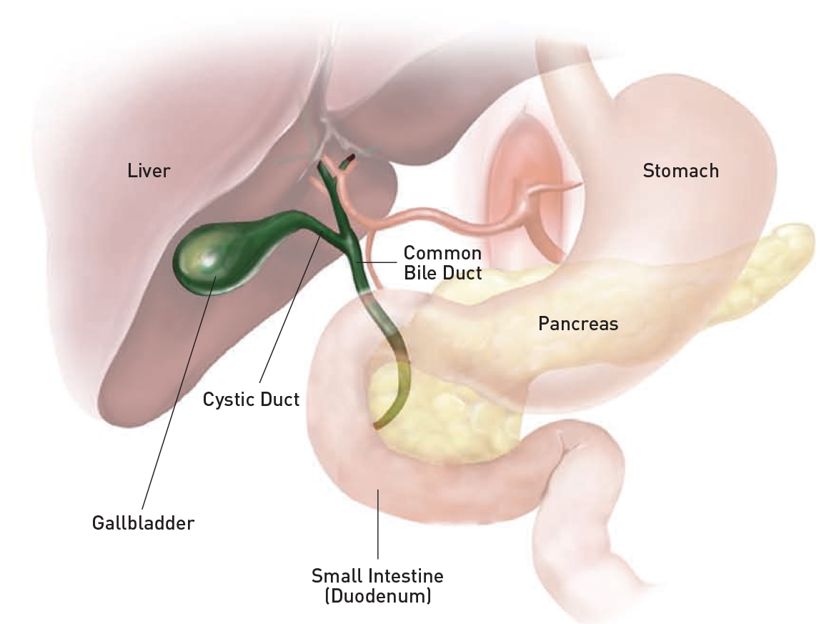 gallstones